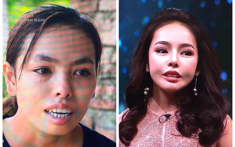 Cô gái bị miệt thị ngoại hình trở nên xinh đẹp hơn nhờ phẫu thuật thẩm mỹ
