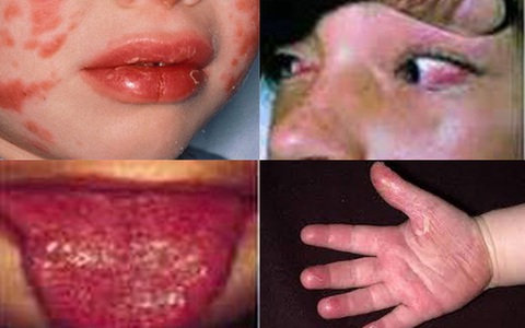 Anh cảnh báo bệnh COVID-19 gây ra biến chứng nguy hiểm ở trẻ nhỏ