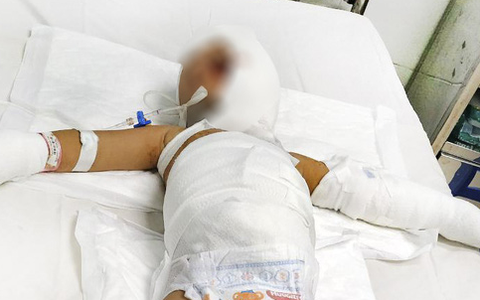 Cứu 2 trẻ bị phỏng nặng trong vụ ném bom xăng ở Bình Dương