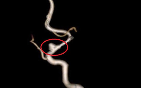 Bé 3 tuổi bị đột quỵ: Có thường gặp, làm sao nhận biết?