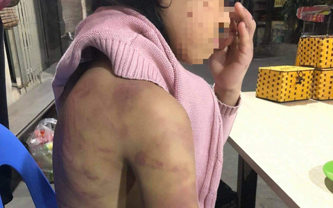Hà Nội chỉ đạo xử lý vụ bé gái 12 tuổi nghi bị bạo hành, xâm hại
