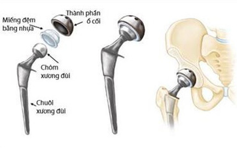 Khớp háng nhân tạo - cứu cánh giúp bệnh nhân gãy cổ xương đùi tránh tàn phế