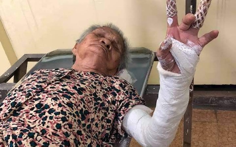 Cụ bà bị gãy xương 2 nơi, bác sĩ bó bột 1 nơi, Bệnh viện Lê Văn Việt nói gì?