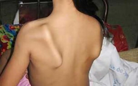 Phẫu thuật thành công cho cô gái mắc bệnh 'chim sệ cánh' 17 năm không thể khép vai
