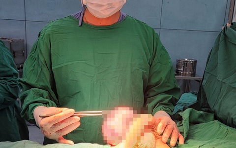Thiếu nữ 15 tuổi mang khối u vú hiếm gặp