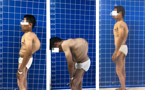 Cắt xương sườn, ‘tái sinh’ cột sống cho bệnh nhân gù lưng hơn 100 độ