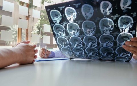 AI giúp chẩn đoán sớm và tìm ra phương pháp điều trị cho người đột quỵ