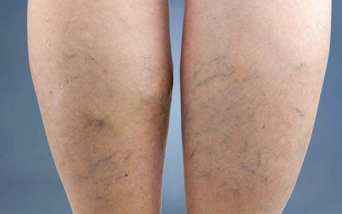 Đứng, ngồi quá lâu chân đau, nguy cơ suy giãn tĩnh mạch