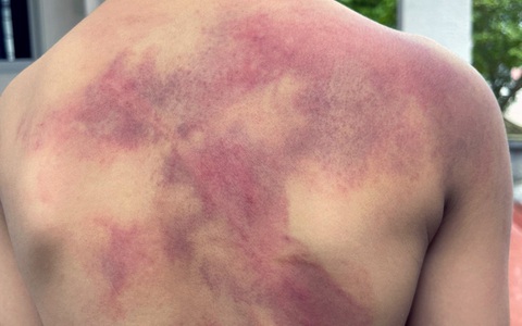 Bé trai 5 tuổi chi chít vết thương khắp người do cha ruột đánh