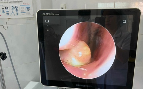 Hy hữu phát hiện cháu bé có răng mọc ngược ở khoang mũi