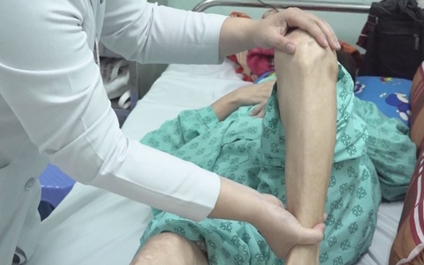 Góc nhìn trưa nay | Bệnh viêm khớp tự miễn nguy hiểm như thế nào?