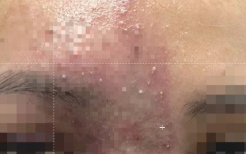 Tiêm filler nâng mũi 'ủng hộ' spa quen, ngờ đâu hoại tử mũi nghiêm trọng