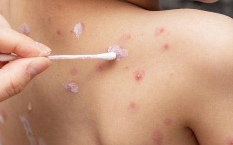 Hà Nội: Một huyện xuất hiện 5 ổ dịch thủy đậu