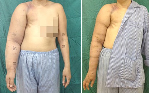 Cứu cánh tay phù to gấp đôi sau điều trị ung thư vú