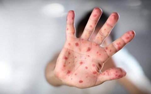Trong 1 tuần, bệnh tay chân miệng tăng vọt ở Phú Yên