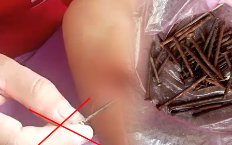 Chủ tịch xã ở Quảng Ngãi nói về video 'hàng chục chiếc đinh trồi ra từ tay người phụ nữ'
