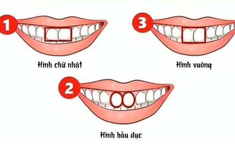 Hình dạng răng cửa nói gì về bạn?