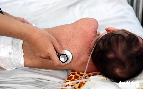 Ca sởi tại Đồng Nai, Bình Dương, TP.HCM và Cà Mau đang tăng rất nhanh