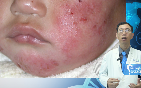 Cảnh báo tình trạng nứt da đầu ở trẻ vì tắm lá chữa viêm da cơ địa