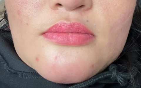 Tiêm filler cằm, người phụ nữ bị nhiễm trùng, chảy đầy dịch mủ trong miệng