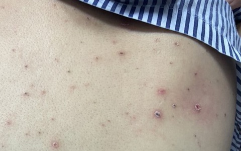 Nhóm bệnh nhân mãn tính mắc thủy đậu sẽ có nhiều biến chứng