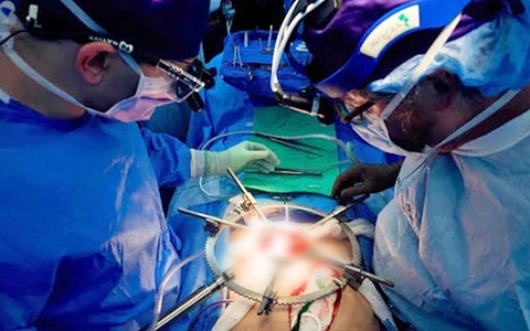Người đầu tiên được ghép thận heo chỉnh sửa gene, sẽ sớm được xuất viện