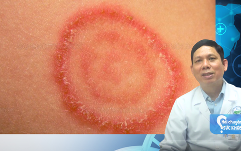Hắc lào dễ bị nhầm lẫn với bệnh nào và cách nhận biết ra sao?