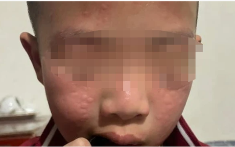 Trẻ bị phát ban, ngứa do thuốc diệt muỗi, tại sao?