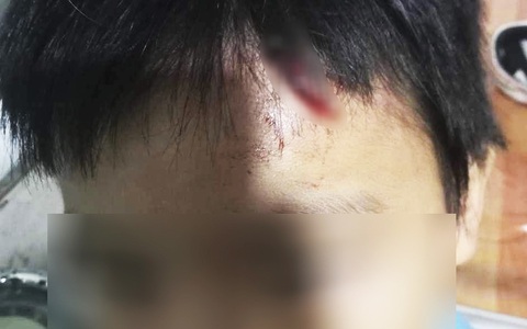 Bé trai bị mẹ kế đánh bể đầu