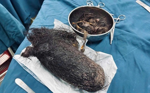 Lấy búi tóc khổng lồ nặng gần 1kg trong dạ dày bé gái 12 tuổi