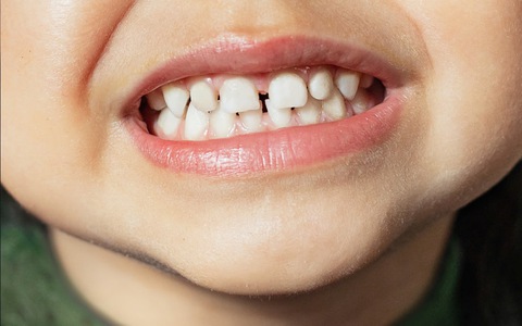Những sai lầm khi chăm sóc răng sữa ở trẻ