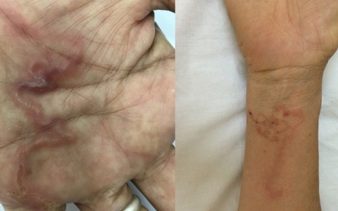 Ghi nhận ca bệnh 'giun rồng' ở Việt Nam, loại giun dài đến hàng mét