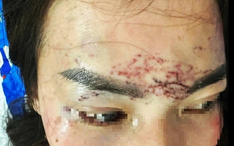 Công an xác minh vụ đánh ghen bằng cách xăm lên mặt ‘tình địch’ xôn xao dư luận ở Cà Mau