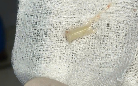 Nghe có tiếng kèn phát ra từ nhịp thở của cậu bé 7 tuổi, người mẹ đi tìm bệnh cho con