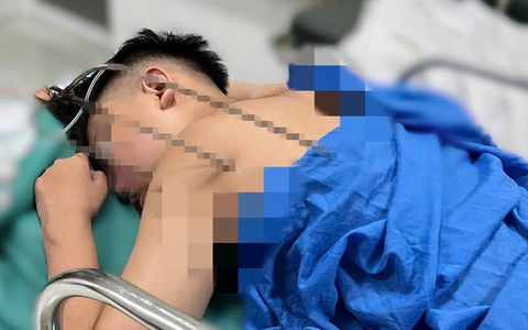 Cấp cứu nam thiếu niên bị đinh ba tự chế đâm thấu tim