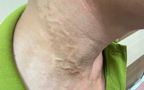Lại phát hiện ca mắc giun rồng ở Phú Thọ