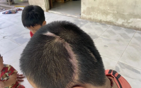 Vụ học sinh lớp 3 bị xe tông tổn thương 90%: Tòa án mời các bên liên quan làm việc lần hai