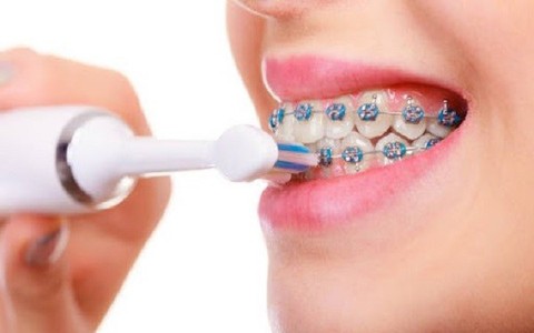 Ăn gì, vệ sinh răng thế nào khi đang niềng răng?