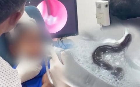 Gắp con đỉa trong đường thở của bệnh nhi 5 tuổi sau 1 tuần liên tục ho ra máu