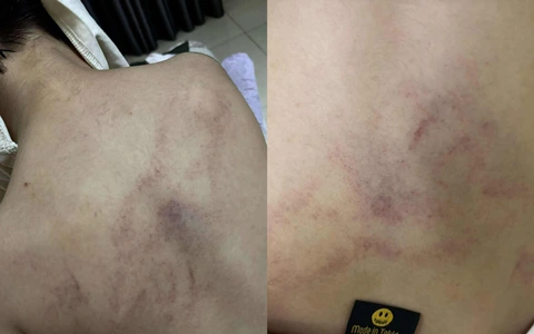 Gia đình tố cô giáo mầm non đánh, kéo lê, ném bé gái 4 tuổi vào tường