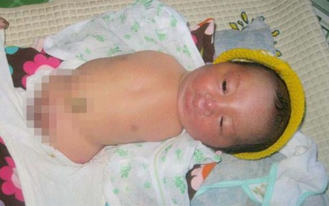 Một bé trai mới sinh không có tay chân