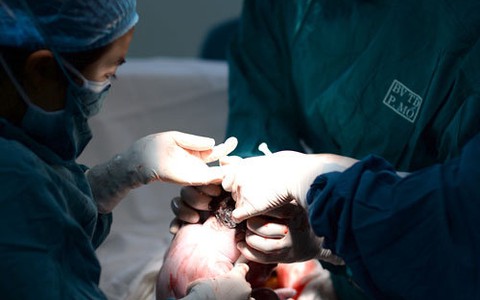 Mổ lấy thai trên 15% nhiều tai biến hơn cho mẹ và con