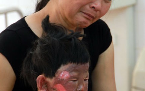 Đổ xăng, 5 người trong một gia đình phỏng nặng