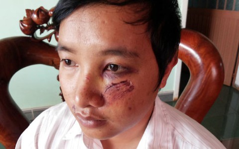 Làm rõ vụ một thầy giáo bị đánh phải nhập viện
