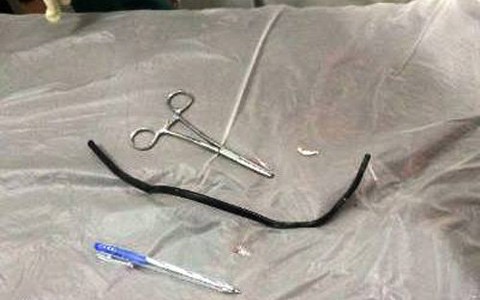 Thách đố nhau, nuốt sợi dây điện gần 40cm vào bụng