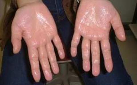 ​Khổ với chứng đổ mồ hôi