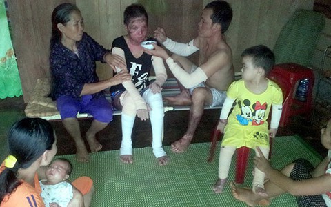 ​Cháy nhà, bỏng cả gia đình