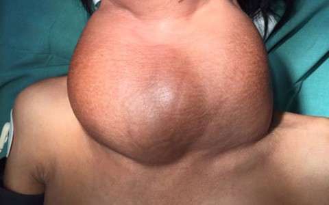 Bướu cổ nặng 1,5 kg