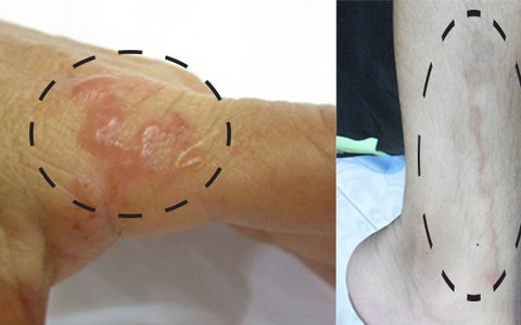Viêm loét dạ dày vì giun lươn