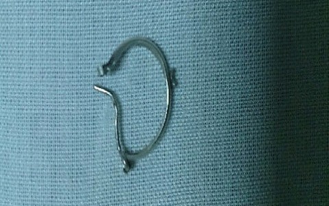 Gắp khuyên tai trong thực quản bệnh nhi 5 tháng tuổi